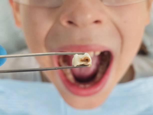 Best Emergency Tooth Extraction in Amador Pines, CA
